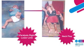 Acute flaccid paralysis , Polio , Transverse myelitis, AFP survillence ...