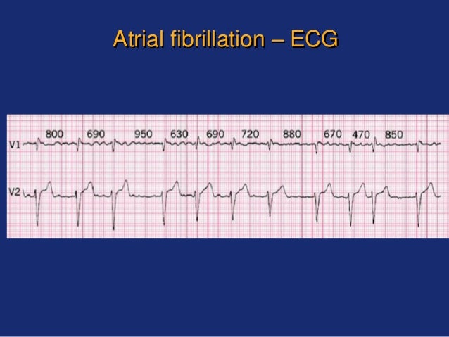 diagnosis code for atrial fibrillation