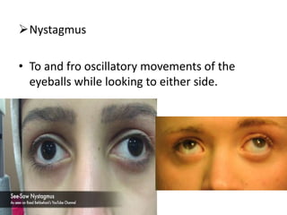 Nystagmus
• To and fro oscillatory movements of the
eyeballs while looking to either side.
 