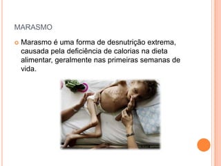 MARASMO
 Marasmo é uma forma de desnutrição extrema,
causada pela deficiência de calorias na dieta
alimentar, geralmente nas primeiras semanas de
vida.
 