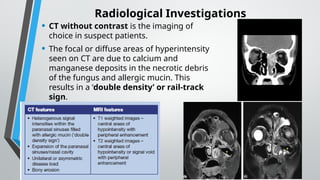 ALLERGIC FUNGAL RHINOSINUSITIS PRESENTATION | PPTX