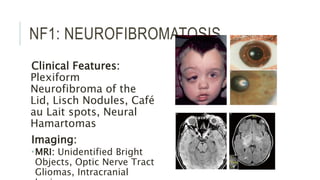 Nf1 Features Paediatric Neuro-Ophthalmology | PPTX