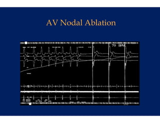 AV Nodal Ablation
      al
      a
 