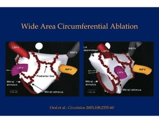 Wide Area Circum
               mferential Ablation




        Oral et al.: Circulat
                            tion 2003;108;2355-60
 