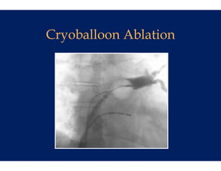 Cryoballoo Ablation
C b ll on Abl ti
 