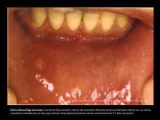 Úlcera aftosa (llaga ulcerosa): Una forma típíca,simple o menor, de ulceración aftosa de la mucosa del labio inferior con un centro
amarillento rodeado por un halo rojo intenso. Estas dolorosas lesiones sanan normalmente en 5-7 días sin cicatriz.
R.Rapp. Atlas a color de casos clínicos en pedontología. Chicago:Year Book Medical Publisher Inc. 1980
 