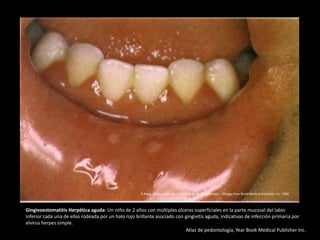 Gingivoestomatitis Herpética aguda: Un niño de 2 años con múltiples úlceras superficiales en la parte mucosal del labio
inferior cada una de ellas rodeada por un halo rojo brillante asociado con gingivitis aguda, indicativas de infección primaria por
elvirus herpes simple.
Atlas de pedontología, Year Book Medical Publisher Inc.
R.Rapp. Atlas a color de casos clínicos en pedontología. Chicago:Year Book Medical Publisher Inc. 1980
 