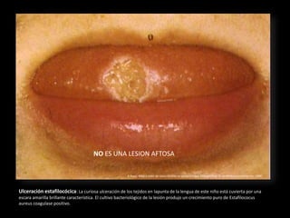 Ulceración estafilocócica: La curiosa ulceración de los tejidos en lapunta de la lengua de este niño está cuvierta por una
escara amarilla brillante característica. El cultivo bacteriológico de la lesión produjo un crecimiento puro de Estafilococus
aureus coagulase positivo.
R.Rapp. Atlas a color de casos clínicos en pedontología. Chicago:Year Book Medical Publisher Inc. 1980
NO ES UNA LESION AFTOSA
 