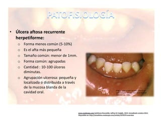 • Úlcera aftosa recurrente
herpetiforme:
o Forma menos común (5-10%)
o Es el afta más pequeña
o Tamaño común: menor de 1mm.
o Forma común: agrupadas
o Cantidad : 10-100 úlceras
diminutas.
o Agrupación ulcerosa: pequeña y
localizada o distribuida a través
de la mucosa blanda de la
cavidad oral.
R.Rapp. Atlas a color de casos clínicos en
pedontología. Chicago:Year Book Medical
Publisher Inc. 1980
 