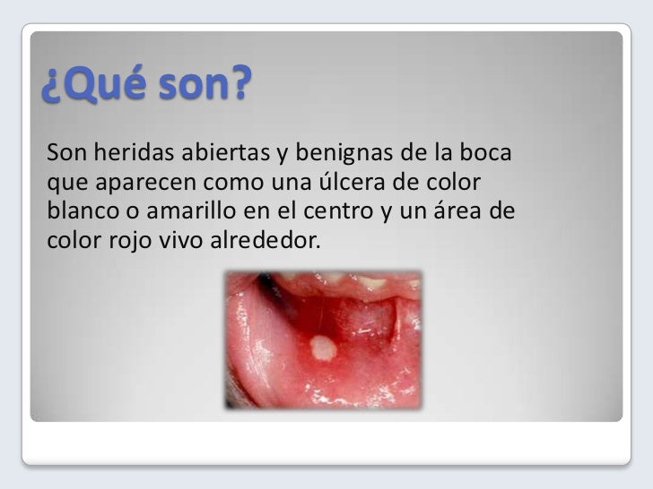 aftas bucales