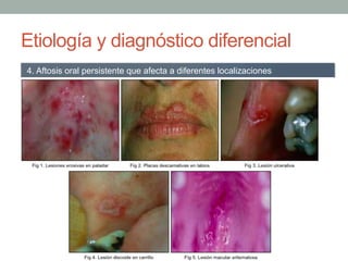 Etiología y diagnóstico diferencial
- Aftosis compleja primaria
-  Liquen plano oral
-  Pénfigo oral
-  EII y Enfermedad celíaca
-  VIH
-  Neutropenia ciclica
-  Síndrome de PFAPA
-  Síndrome MAGIC
-  Déficit de vitaminas
-  Leucemia
-  Fármacos
-  Enterocolitis por Yersinia, enterocolitis tuberculosa y fiebre tifoidea
-  LES
4. Aftosis oral persistente que afecta a diferentes localizaciones
 