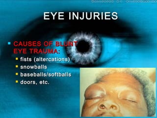 EYE INJURIESEYE INJURIES
 CAUSES OF BLUNTCAUSES OF BLUNT
EYE TRAUMA:EYE TRAUMA:
 fists (altercations)fists (altercations)
 snowballssnowballs
 baseballs/softballsbaseballs/softballs
 doors, etc.doors, etc.
 