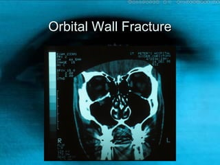Orbital Wall FractureOrbital Wall Fracture
 