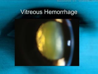 Vitreous HemorrhageVitreous Hemorrhage
 