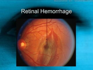 Retinal HemorrhageRetinal Hemorrhage
 