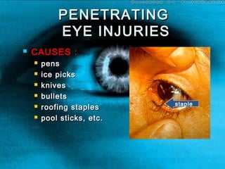 PENETRATINGPENETRATING
EYE INJURIESEYE INJURIES
 CAUSES :CAUSES :
 penspens
 ice picksice picks
 knivesknives
 bulletsbullets
 roofing staplesroofing staples
 pool sticks, etc.pool sticks, etc.
staple
 