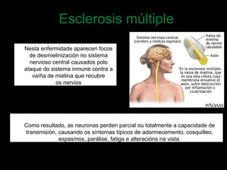 Esclerosis múltiple
Como resultado, as neuronas perden parcial ou totalmente a capacidade de
transmisión, causando os síntomas típicos de adormecemento, cosquilleo,
espasmos, parálise, fatiga e alteracións na vista.
Nesta enfermidade aparecen focos
de desmielinización no sistema
nervioso central causados polo
ataque do sistema inmune contra a
vaíña de mielina que recubre
os nervios
 