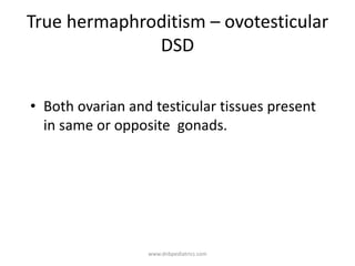 True hermaphroditism – ovotesticular
DSD
• Both ovarian and testicular tissues present
in same or opposite gonads.
www.dnbpediatrics.com
 