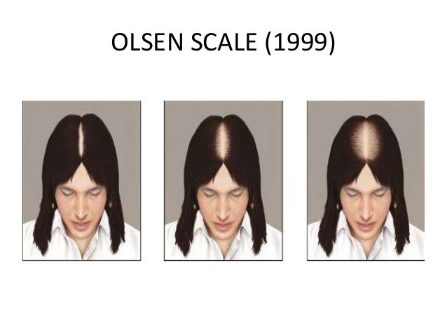 Grading Staging in Androgenetic Alopecia (Male Pattern Baldness) by A…