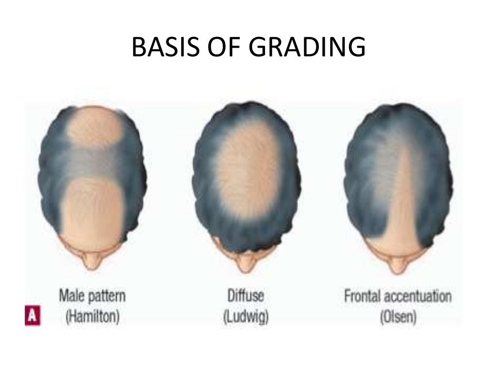 Grading Staging in Alopecia (Male Pattern Baldness) by A…