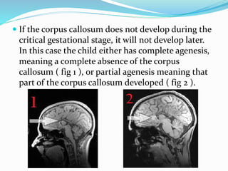 Agenesis of The Corpus Callosum ACC | PPTX