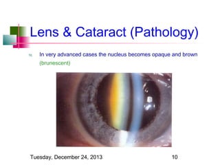 Lens & Cataract (Pathology)
10.

In very advanced cases the nucleus becomes opaque and brown
(brunescent)

Tuesday, December 24, 2013

10

 