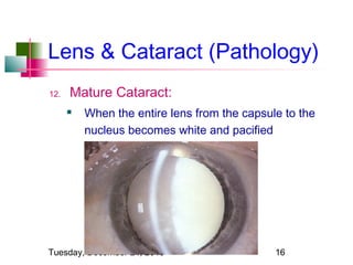 Lens & Cataract (Pathology)
12.

Mature Cataract:


When the entire lens from the capsule to the
nucleus becomes white and pacified

Tuesday, December 24, 2013

16

 