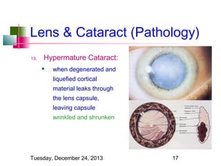 Lens & Cataract (Pathology)
13.

Hypermature Cataract:


when degenerated and
liquefied cortical
material leaks through
the lens capsule,
leaving capsule
wrinkled and shrunken

Tuesday, December 24, 2013

17

 