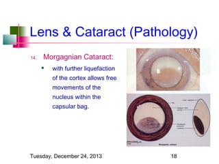 Lens & Cataract (Pathology)
14.

Morgagnian Cataract:


with further liquefaction
of the cortex allows free
movements of the
nucleus within the
capsular bag.

Tuesday, December 24, 2013

18

 