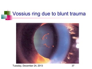 Vossius ring due to blunt trauma

Tuesday, December 24, 2013

37

 