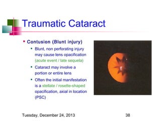 Traumatic Cataract


Contusion (Blunt injury)






Blunt, non perforating injury
may cause lens opacification
(acute event / late sequela)
Cataract may involve a
portion or entire lens
Often the initial manifestation
is a stellate / rosette-shaped
opacification, axial in location
(PSC)

Tuesday, December 24, 2013

38

 