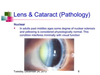 Lens & Cataract (Pathology)
Nuclear

In adults past middles ages some degree of nuclear sclerosis
and yellowing is considered physiologically normal. This
condition interferes minimally with visual function

Tuesday, December 24, 2013

6

 
