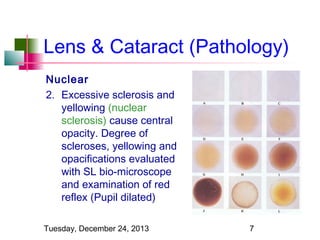 Lens & Cataract (Pathology)
Nuclear
2. Excessive sclerosis and
yellowing (nuclear
sclerosis) cause central
opacity. Degree of
scleroses, yellowing and
opacifications evaluated
with SL bio-microscope
and examination of red
reflex (Pupil dilated)
Tuesday, December 24, 2013

7

 