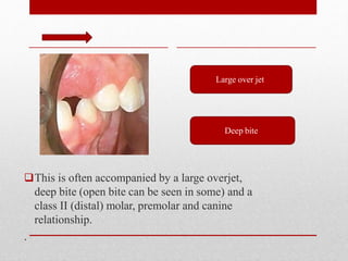 This is often accompanied by a large overjet,
deep bite (open bite can be seen in some) and a
class II (distal) molar, premolar and canine
relationship.
.
Large over jet
Deep bite
 