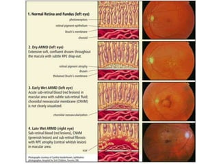 Age related macular degeneration | PPTX