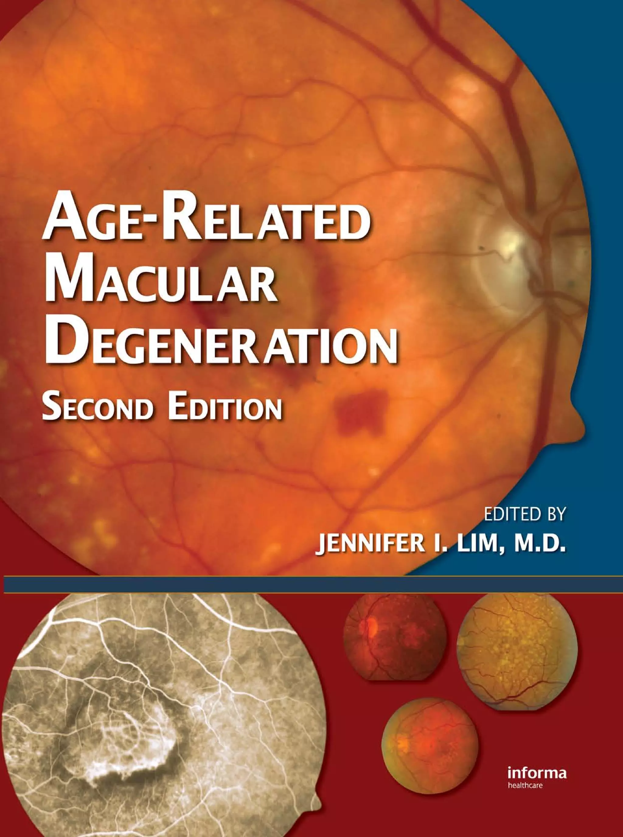 Age related macular-degeneration__2nd_edition | PDF