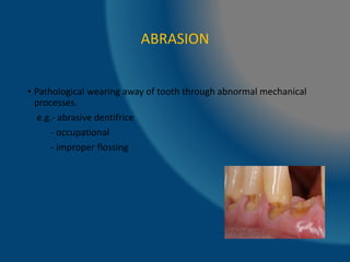 ABRASION
• Pathological wearing away of tooth through abnormal mechanical
processes.
e.g.- abrasive dentifrice
- occupational
- improper flossing
 