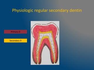 Physiologic regular secondary dentin
Secondary D
Primary D
 