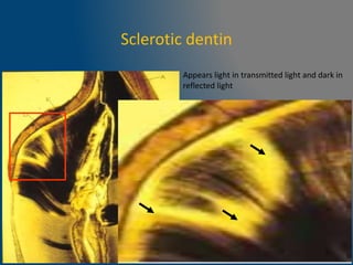 Sclerotic dentin
Appears light in transmitted light and dark in
reflected light
 