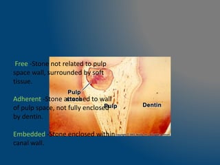 Free -Stone not related to pulp
space wall, surrounded by soft
tissue.
Adherent -Stone attached to wall
of pulp space, not fully enclosed
by dentin.
Embedded -Stone enclosed within
canal wall.
 