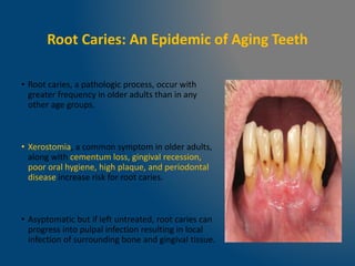 Root Caries: An Epidemic of Aging Teeth
• Root caries, a pathologic process, occur with
greater frequency in older adults than in any
other age groups.
• Xerostomia, a common symptom in older adults,
along with cementum loss, gingival recession,
poor oral hygiene, high plaque, and periodontal
disease increase risk for root caries.
• Asyptomatic but if left untreated, root caries can
progress into pulpal infection resulting in local
infection of surrounding bone and gingival tissue.
 