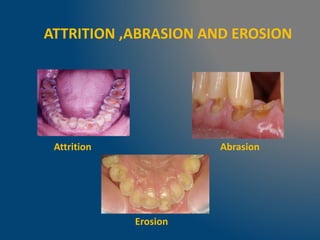 ATTRITION ,ABRASION AND EROSION
Attrition Abrasion
Erosion
 