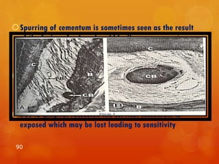 Spurring of cementum is sometimes seen as the result
of the fusion of calcospheroid bodies near cementum or
of the calcification of epithelial rest aggregates.
Composition also changes , content of fluoride and
magnesium.
Due to gingival recession the cervical cementum is
exposed which may be lost leading to sensitivity
90
 