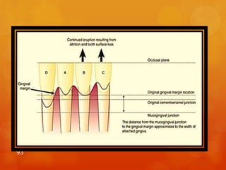 The recession of the gingiva is the result of
occlusal migration of teeth compensating for
occlusal wear and a stable location of the
gingival margin. In other words the gingiva
cannot keep even pace with the migrating teeth
and consequently recession takes place.
93
 