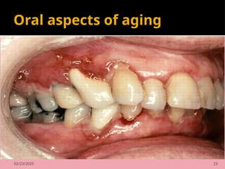 02/23/2025 23
Oral aspects of aging
 