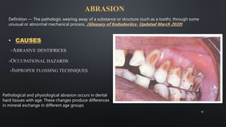 ABRASION
• CAUSES
Pathological and physiological abrasion occurs in dental
hard tissues with age. These changes produce differences
in mineral exchange in different age groups
Definition — The pathologic wearing away of a substance or structure (such as a tooth), through some
unusual or abnormal mechanical process. (Glossary of Endodontics- Updated March 2020)
36
 