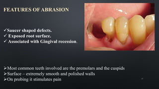 FEATURES OF ABRASION
Most common teeth involved are the premolars and the cuspids
Surface – extremely smooth and polished walls
On probing it stimulates pain 37
Saucer shaped defects.
 Exposed root surface.
 Associated with Gingival recession.
 