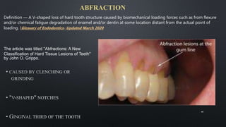 ABFRACTION
40
The article was titled "Abfractions: A New
Classification of Hard Tissue Lesions of Teeth"
by John O. Grippo.
Definition — A V-shaped loss of hard tooth structure caused by biomechanical loading forces such as from flexure
and/or chemical fatigue degradation of enamel and/or dentin at some location distant from the actual point of
loading. (Glossary of Endodontics- Updated March 2020
 