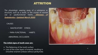 ATTRITION
The physiologic wearing away of a substance or
structure, such as a tooth, in the course of normal
use or parafunctional habits. (Glossary of
Endodontics- Updated March 2020)
The initial signs of tooth wear are-
 The flattening of the tooth surface
 Loss of the outer layers of enamel, resulting in
smoother enamel surfaces without perikymata
41
CAUSES:
- MASTICATORY STRESS
- PARA-FUNCTIONAL HABITS.
-ABNORMAL OCCLUSION
 