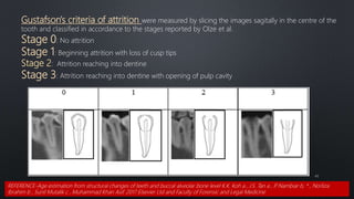43
Gustafson's criteria of attrition were measured by slicing the images sagitally in the centre of the
tooth and classified in accordance to the stages reported by Olze et al.
Stage 0: No attrition
Stage 1: Beginning attrition with loss of cusp tips
Stage 2: Attrition reaching into dentine
Stage 3: Attrition reaching into dentine with opening of pulp cavity
REFERENCE-Age estimation from structural changes of teeth and buccal alveolar bone level K.K. Koh a , J.S. Tan a , P
. Nambiar b, * , Norliza
Ibrahim b , Sunil Mutalik c , Muhammad Khan Asif. 2017 Elsevier Ltd and Faculty of Forensic and Legal Medicine
 